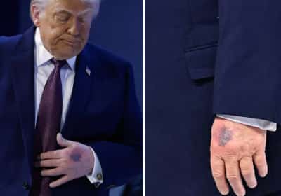 אלצהיימר ושטף דם על גב היד: הנשיא טראמפ מגיב לשמועות על מצבו הרפואי