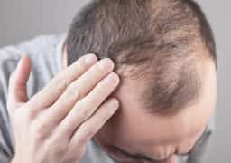 טיפול מפתיע להתקרחות? התרופה שהצמיחה מחדש את רוב השיער