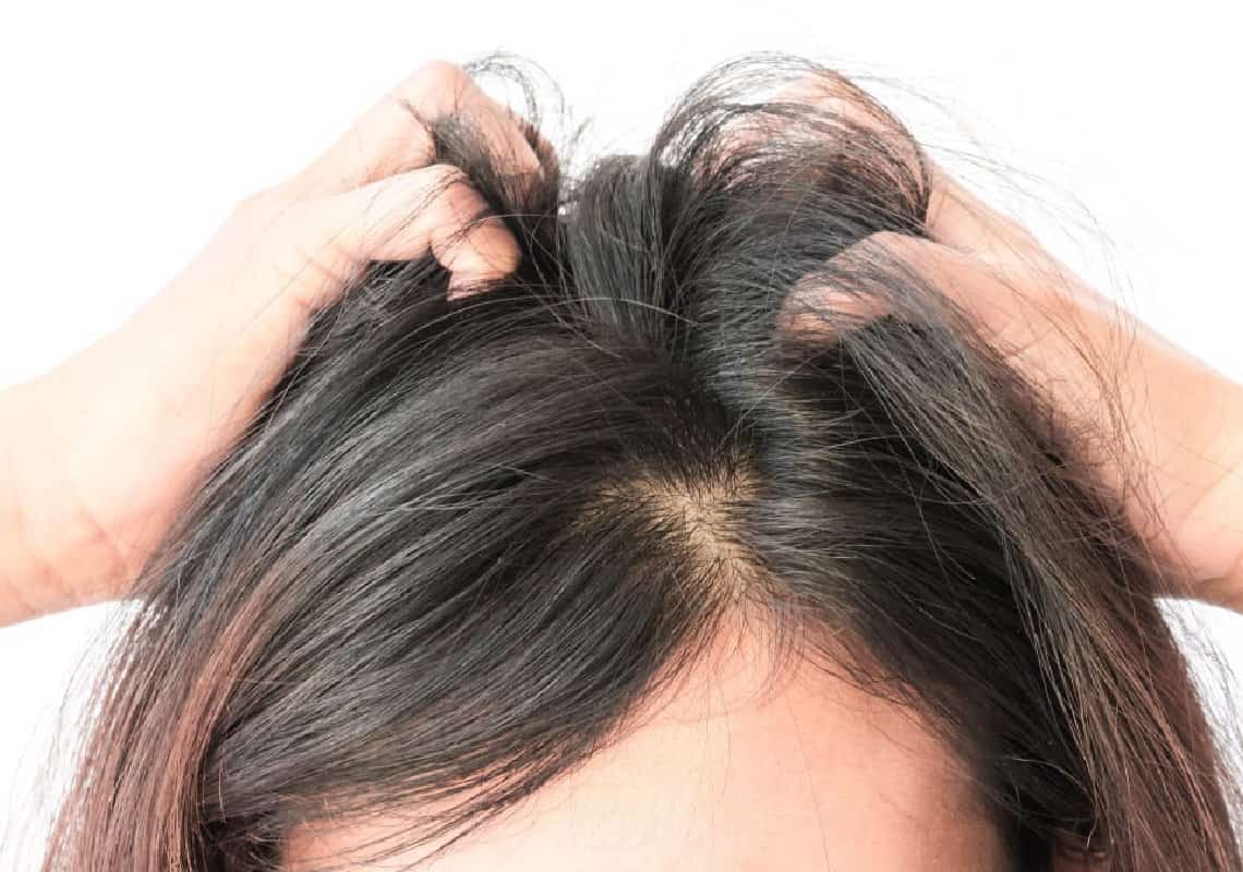 סובלים מיובש בקרקפת? כך תטפלו 