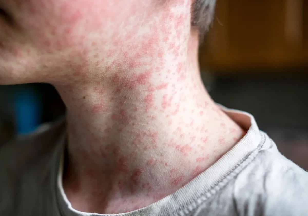 מקרה נוסף של חצבת בלוס אנג'לס: הרשויות פרסמו את מסלול החשיפה מ-LAX ועד הוואלי