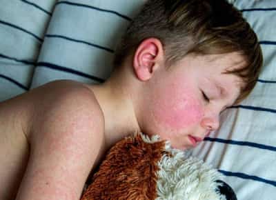 החצבת חוזרת לאמריקה: המחלה שנעלמה מאיימת שוב על ילדים