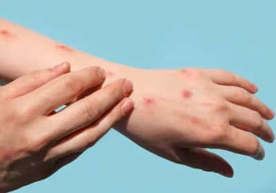 מקרה ראשון בניו יורק: זן אלים של אבעבועות הקוף התגלה בעיר