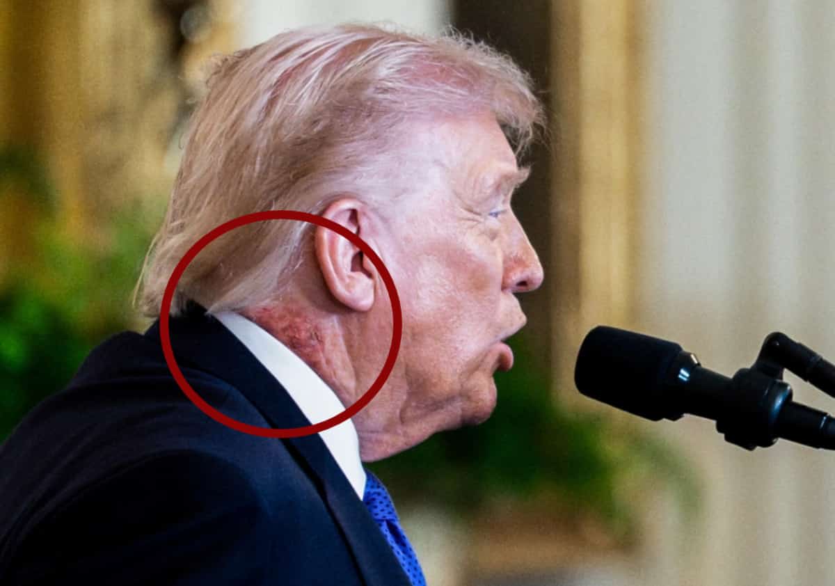 טראמפ נצפה עם פריחה אדומה בצוואר: הרשת סוערת, הרופאים עונים