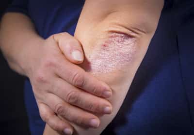 בשורה למתמודדים עם פסוריאזיס: אור ירוק לטיפול תרופתי חדש