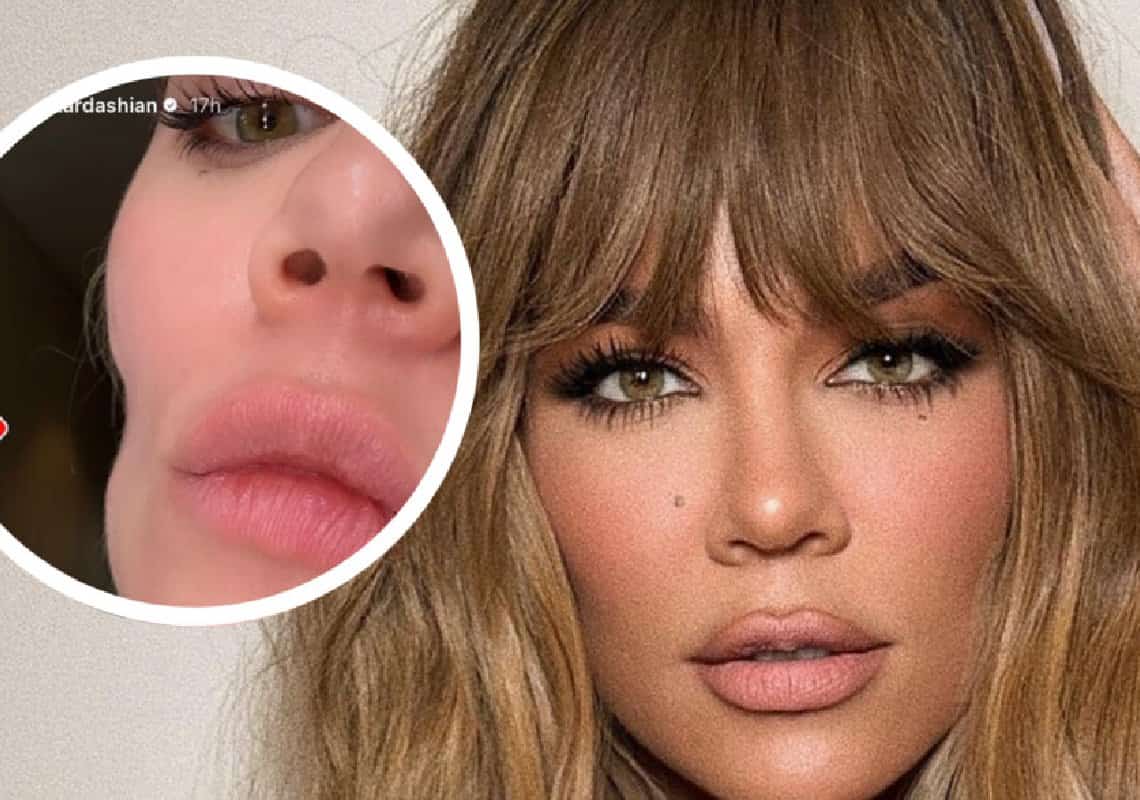 אחרי שהסירה גידול סרטני: קלואי קרדשיאן חושפת שקע גדול בפניה