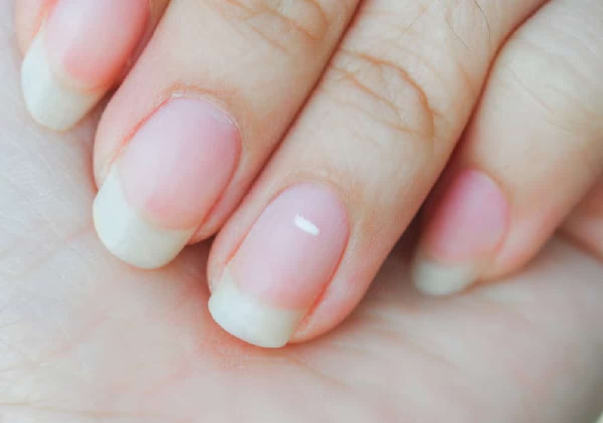 גם אתם בטוחים שכתמים לבנים על הציפורן מעידים על מחסור בסידן? אז זה הזמן לשבור את המיתוס