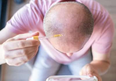 מדענים בטייוואן פיתחו סרום חדש שהצליח להצמיח שיער תוך 20 ימים בלבד