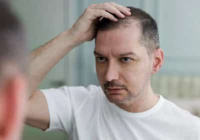 פריצת דרך נגד התקרחות? גלולה חדשה הציגה תוצאות מבטיחות
